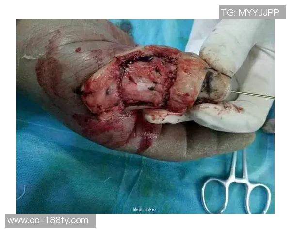 麦凯恩成功接受拇指韧带修复手术预计缺阵至少一个月 麦凯恩成功接受拇指韧带修复手术预计缺阵至少一个月